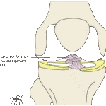 Knee arthroscopy