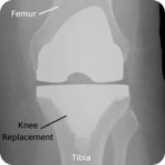 Knee replacement Melbourne